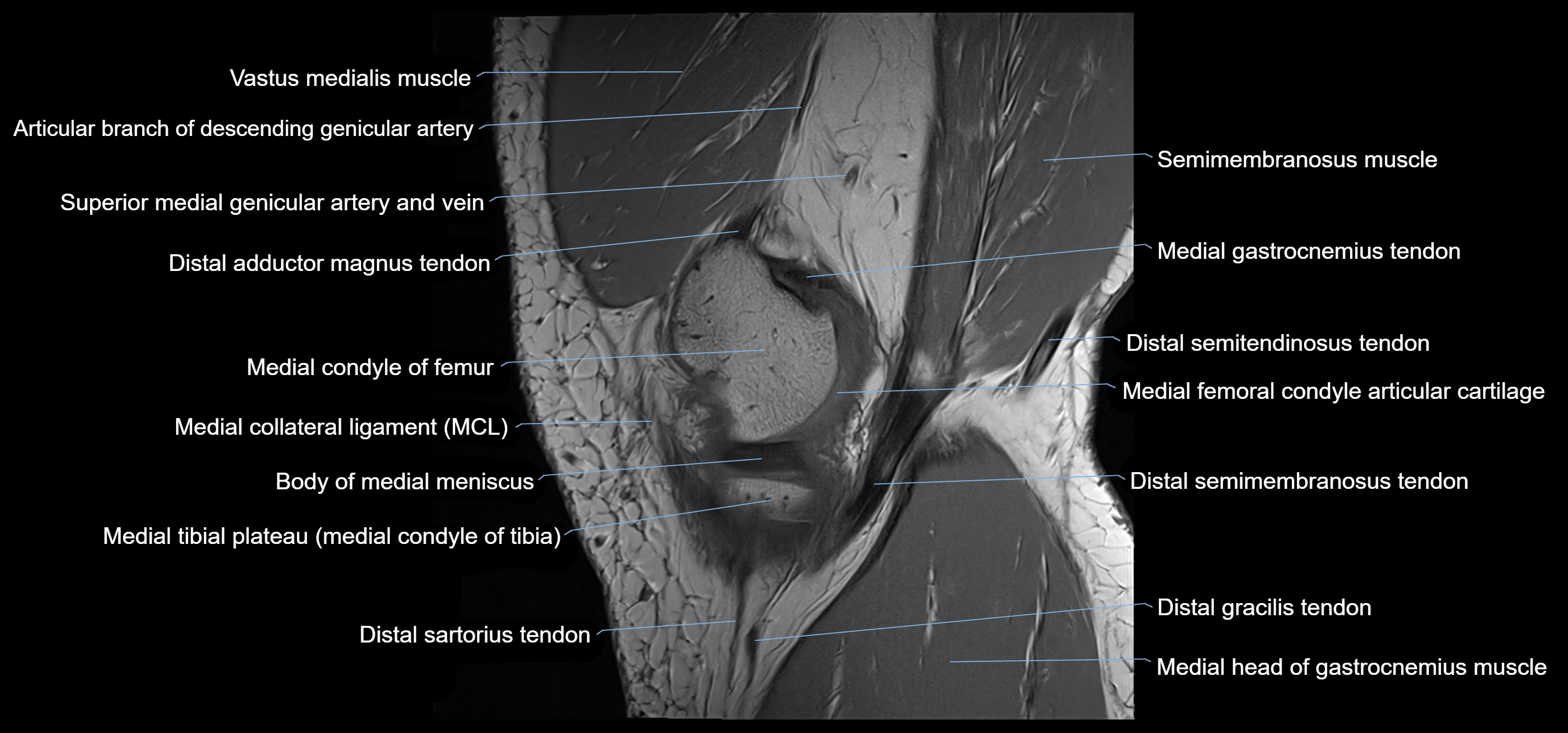 MRI knee sagittal cross sectional anatomy labelled 3T radiology image-00010.webp